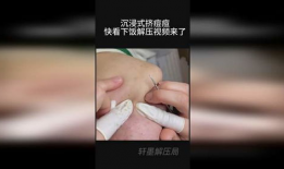 挤痘痘视频,专业视频教你正确操作